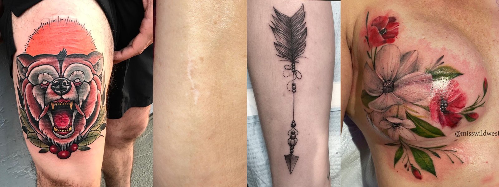 Scar Coverups Using Tattoos